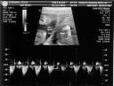 150 bpm heart rate [Ultrasound11.jpg]