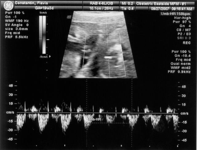 150 bpm heart rate [Ultrasound11.jpg]