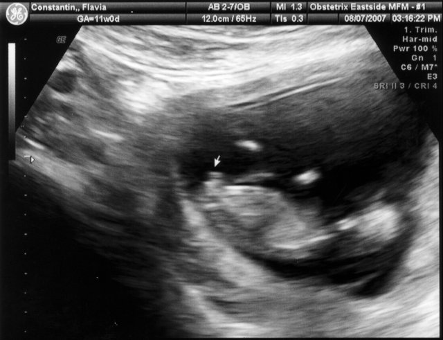 Looks like we'll have a boy [Ultrasound3.jpg]
